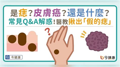 腳背突然長痣|是痣？皮膚癌？還是什麼？常見Q&A解惑！醫教揪出「。